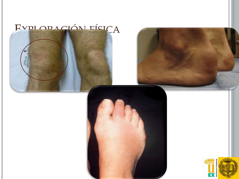 Exploración física Sinovitis de pie, tobillo y rodilla izquierdos.