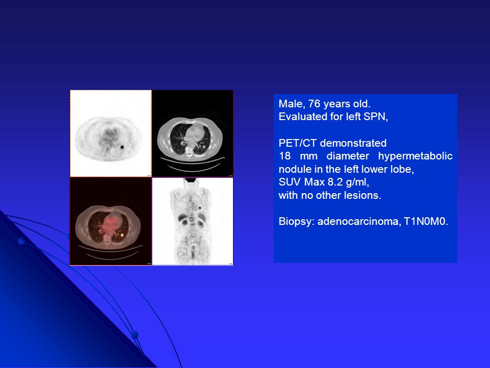 Male, 76 years old. Evaluated for left SPN, PET/CT demonstrated. 18 mm diameter hypermetabolic nodule in the left lower lobe,