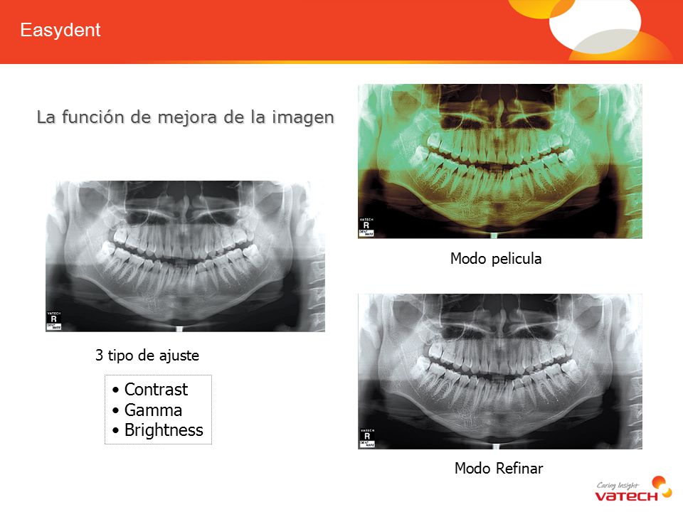 Easydent La función de mejora de la imagen • Contrast • Gamma