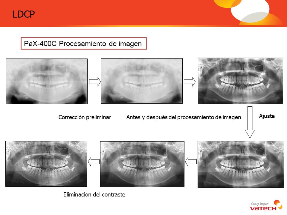 LDCP PaX-400C Procesamiento de imagen Corrección preliminar
