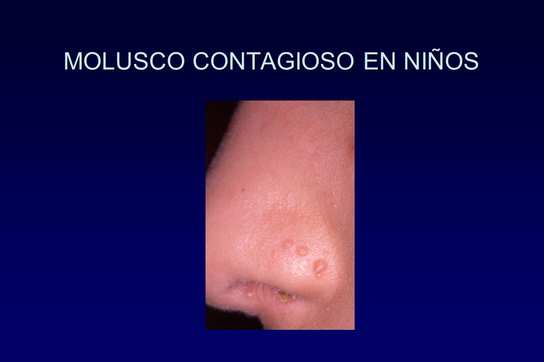 MOLUSCO CONTAGIOSO EN NIÑOS
