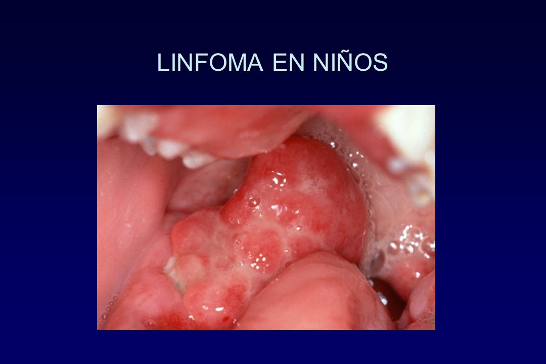 LINFOMA EN NIÑOS Clínicamente, los resultados orales asociados con el linfoma no Hodgkin (LNH) incluyen: