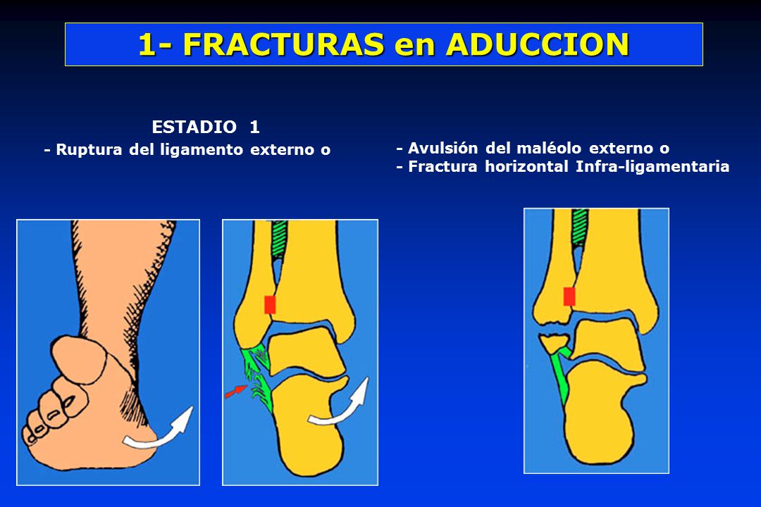 ESTADIO 1 - Ruptura del ligamento externo o