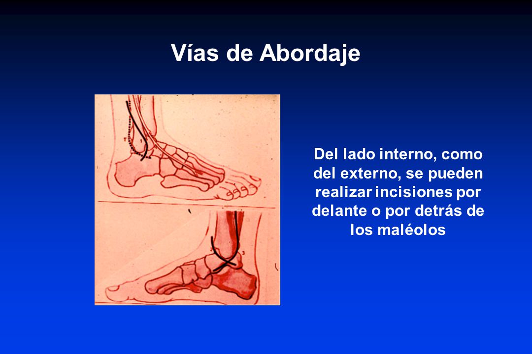 Vías de Abordaje Del lado interno, como del externo, se pueden realizar incisiones por delante o por detrás de los maléolos.