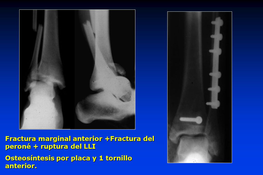 Fractura marginal anterior +Fractura del peroné + ruptura del LLI
