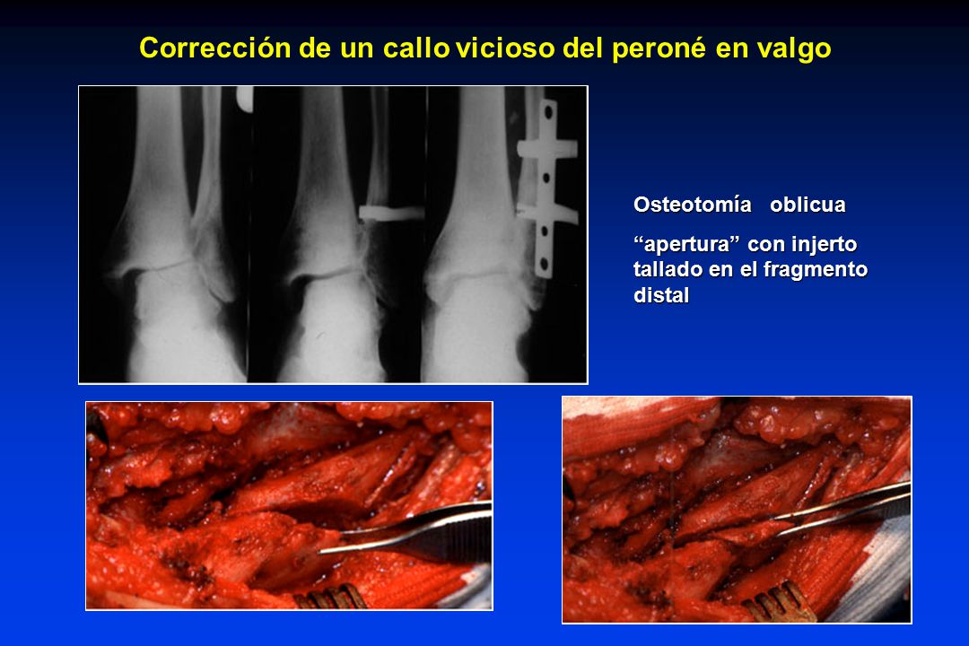 Corrección de un callo vicioso del peroné en valgo