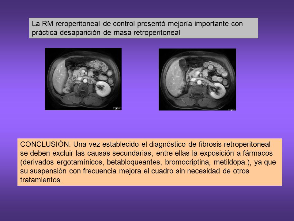 La RM reroperitoneal de control presentó mejoría importante con práctica desaparición de masa retroperitoneal