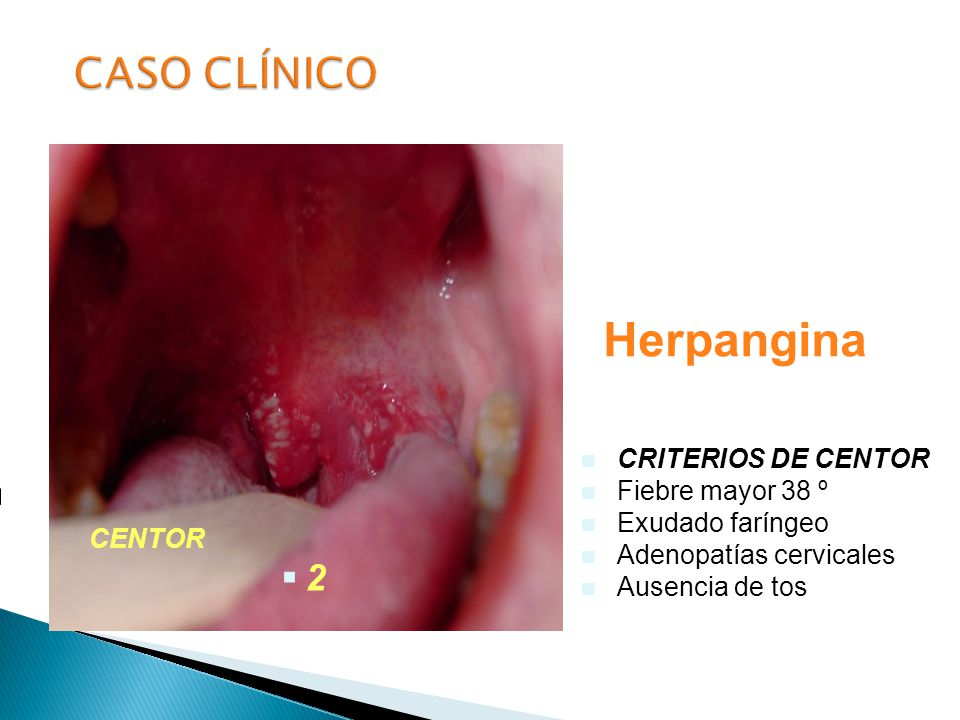 Herpangina CASO CLÍNICO 2 CRITERIOS DE CENTOR Fiebre mayor 38 º