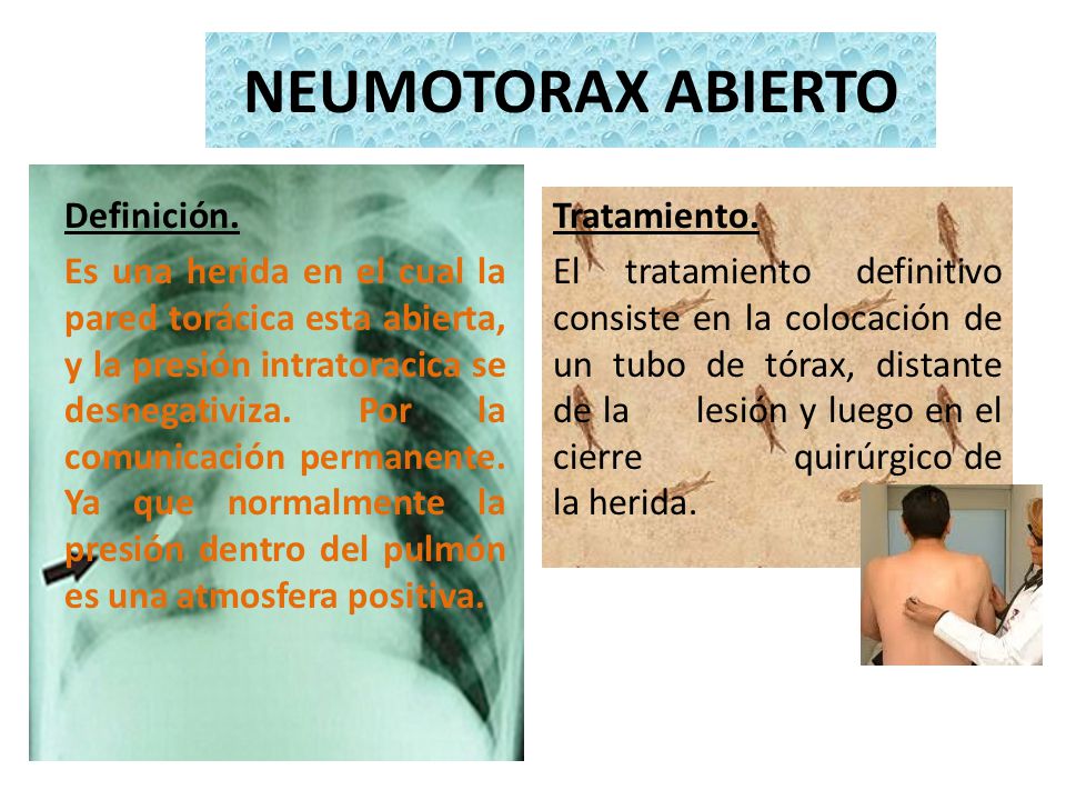 NEUMOTORAX ABIERTO