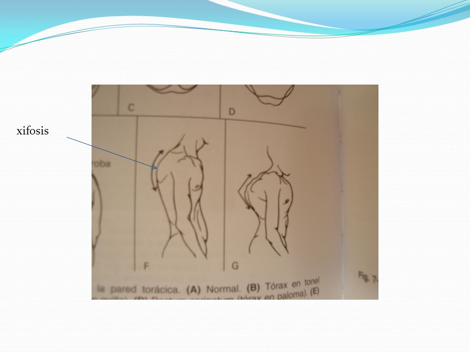 xifosis