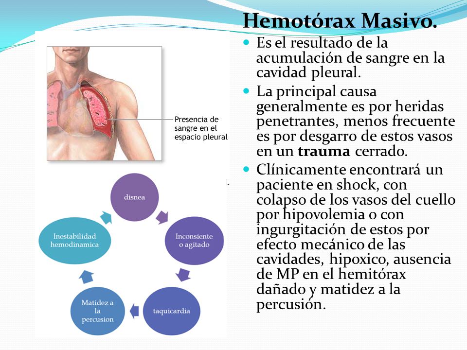 Hemotórax Masivo. Es el resultado de la acumulación de sangre en la cavidad pleural.