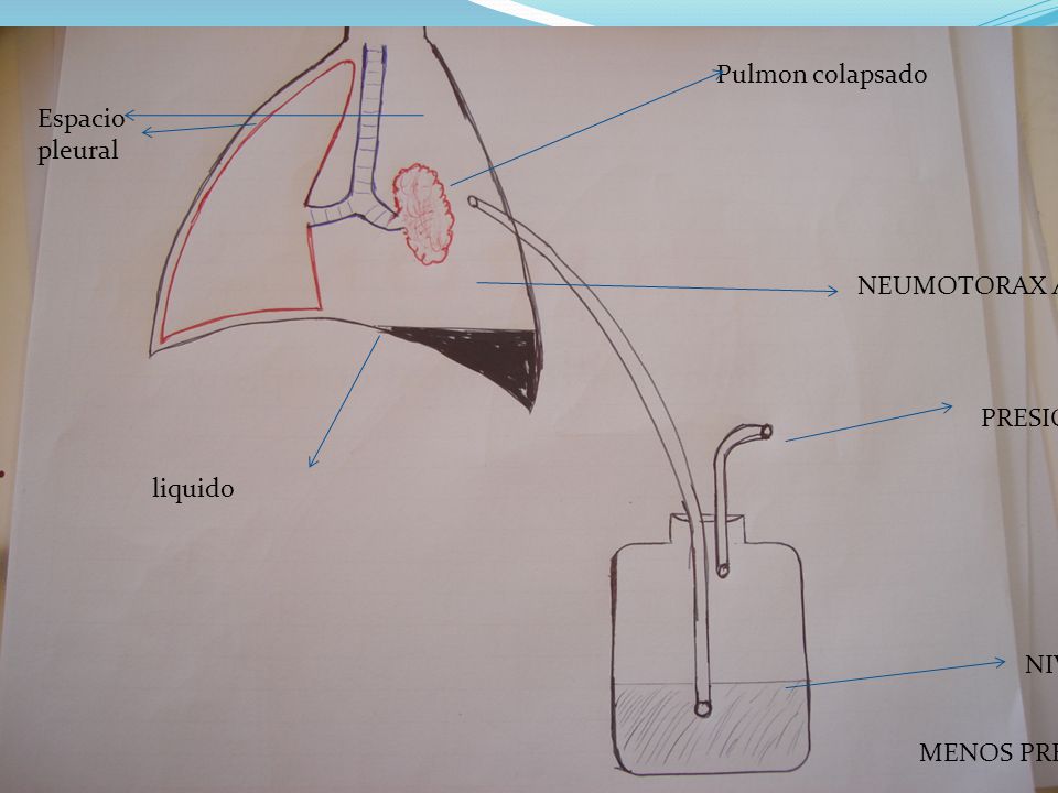 Pulmon colapsado Espacio pleural NEUMOTORAX AIRE PRESION ATM liquido NIVEL LIQUIDO MENOS PRESION
