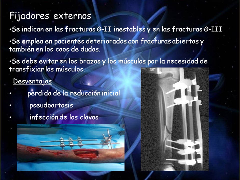 Fijadores externos Se indican en las fracturas G-II inestables y en las fracturas G-III.