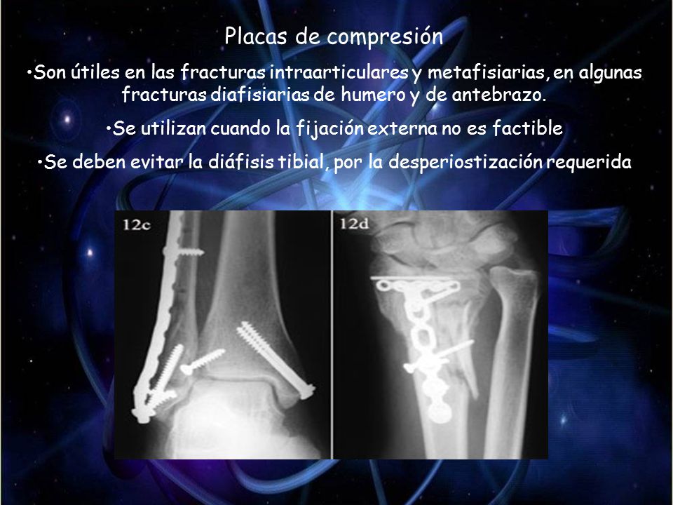 Placas de compresión Son útiles en las fracturas intraarticulares y metafisiarias, en algunas fracturas diafisiarias de humero y de antebrazo.