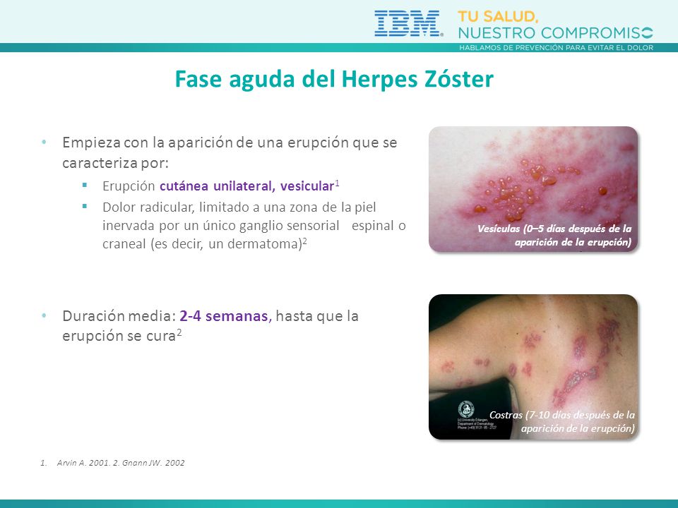 Fase aguda del Herpes Zóster