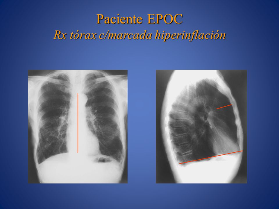 Paciente EPOC Rx tórax c/marcada hiperinflación