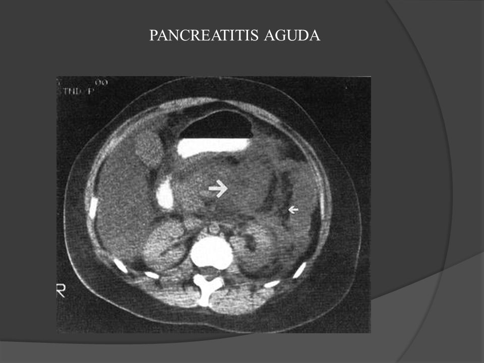 PANCREATITIS AGUDA