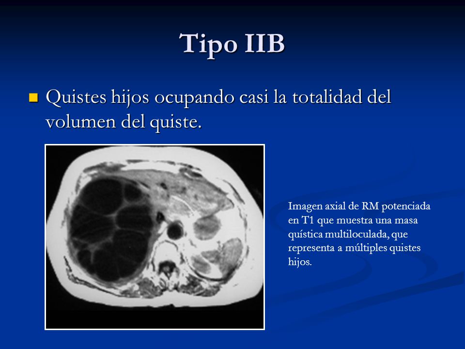 Tipo IIB Quistes hijos ocupando casi la totalidad del volumen del quiste.