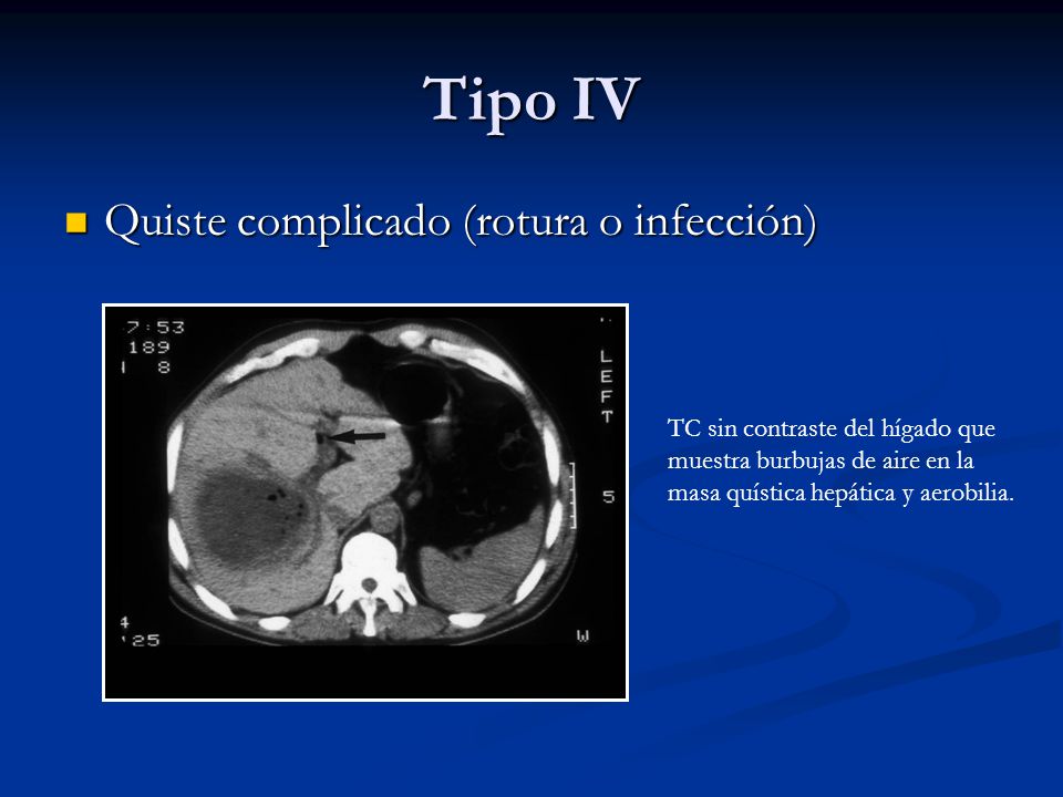 Tipo IV Quiste complicado (rotura o infección)