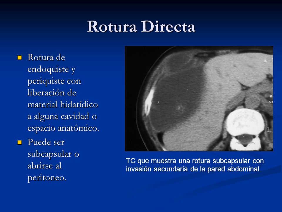 Rotura Directa Rotura de endoquiste y periquiste con liberación de material hidatídico a alguna cavidad o espacio anatómico.