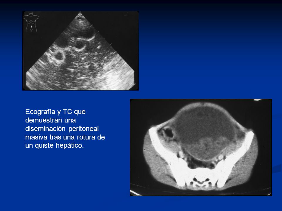 Ecografía y TC que demuestran una diseminación peritoneal masiva tras una rotura de un quiste hepático.
