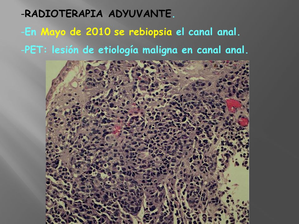 RADIOTERAPIA ADYUVANTE. En Mayo de 2010 se rebiopsia el canal anal.