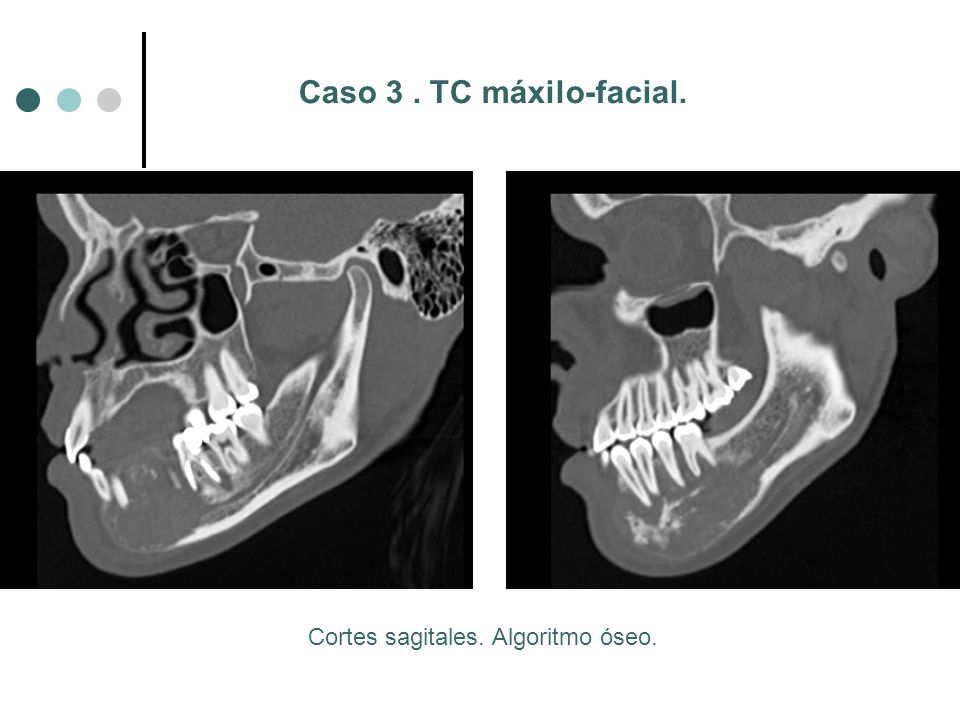 Caso 3 . TC máxilo-facial. Cortes sagitales. Algoritmo óseo.