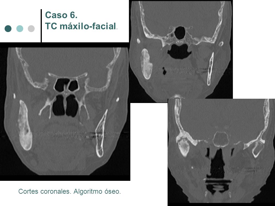 Caso 6. TC máxilo-facial. Cortes coronales. Algoritmo óseo.