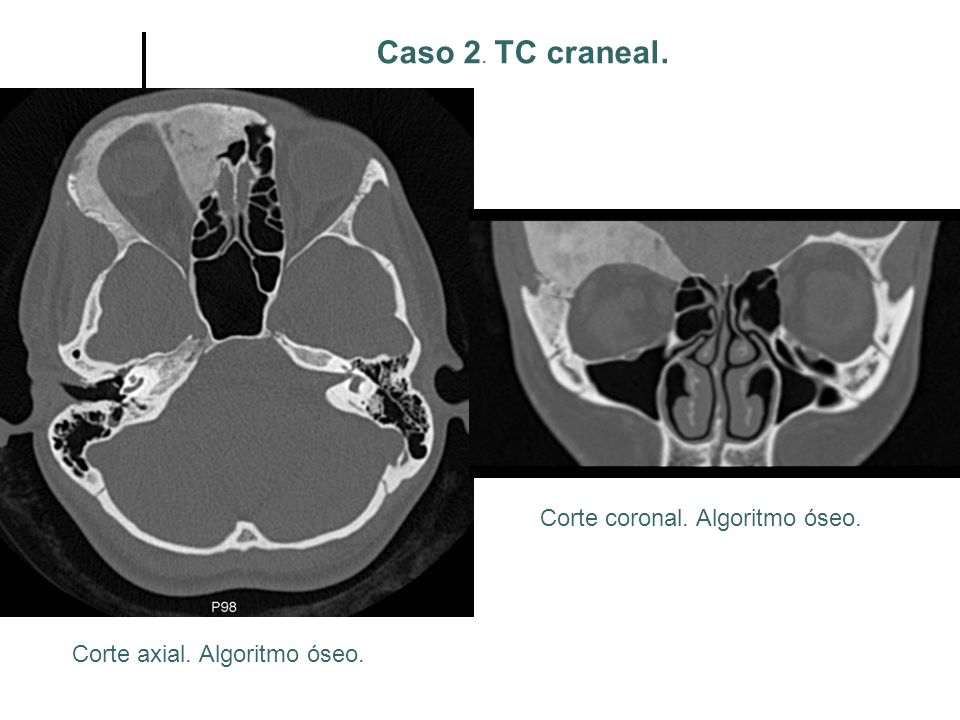 Caso 2. TC craneal. Corte coronal. Algoritmo óseo.