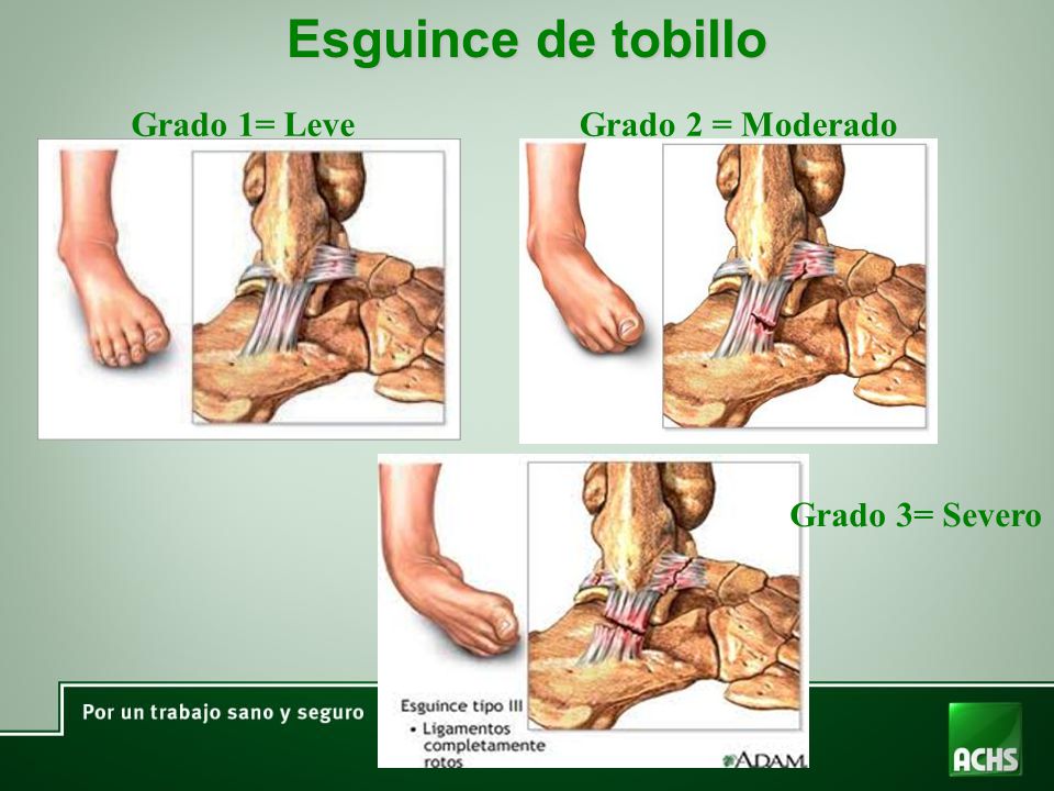 Esguince de tobillo Grado 1= Leve Grado 2 = Moderado Grado 3= Severo