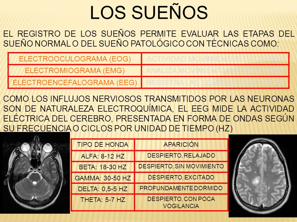 LOS SUEÑOS EL REGISTRO DE LOS SUEÑOS PERMITE EVALUAR LAS ETAPAS DEL SUEÑO NORMAL O DEL SUEÑO PATOLÓGICO CON TÉCNICAS COMO: