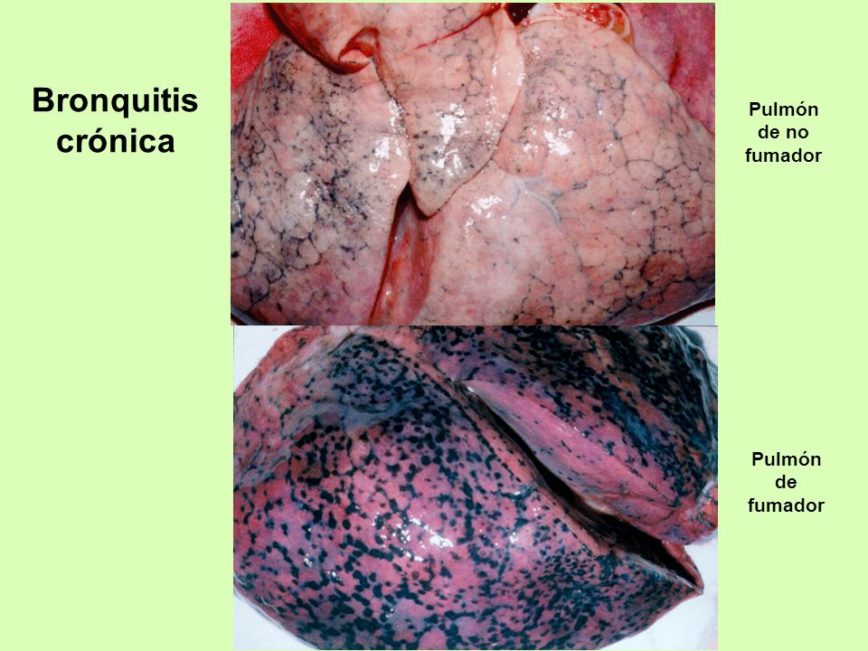 Pulmón de no fumador Bronquitis crónica Pulmón de fumador