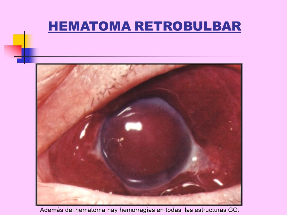 HEMATOMA RETROBULBAR Además del hematoma hay hemorragias en todas las estructuras GO.