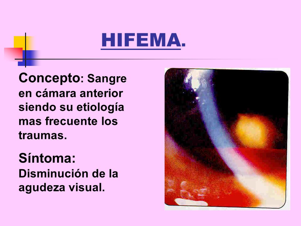 HIFEMA. Concepto: Sangre en cámara anterior siendo su etiología mas frecuente los traumas.