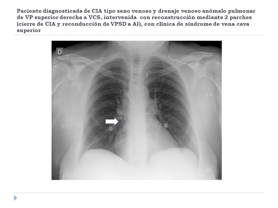 Paciente diagnosticada de CIA tipo seno venoso y drenaje venoso anómalo pulmonar de VP superior derecha a VCS, intervenida con reconstrucción mediante 2 parches (cierre de CIA y reconducción de VPSD a AI), con clínica de síndrome de vena cava superior