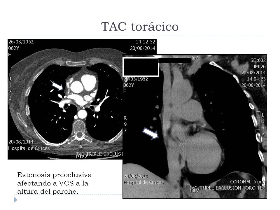TAC torácico Estenosis preoclusiva afectando a VCS a la altura del parche.