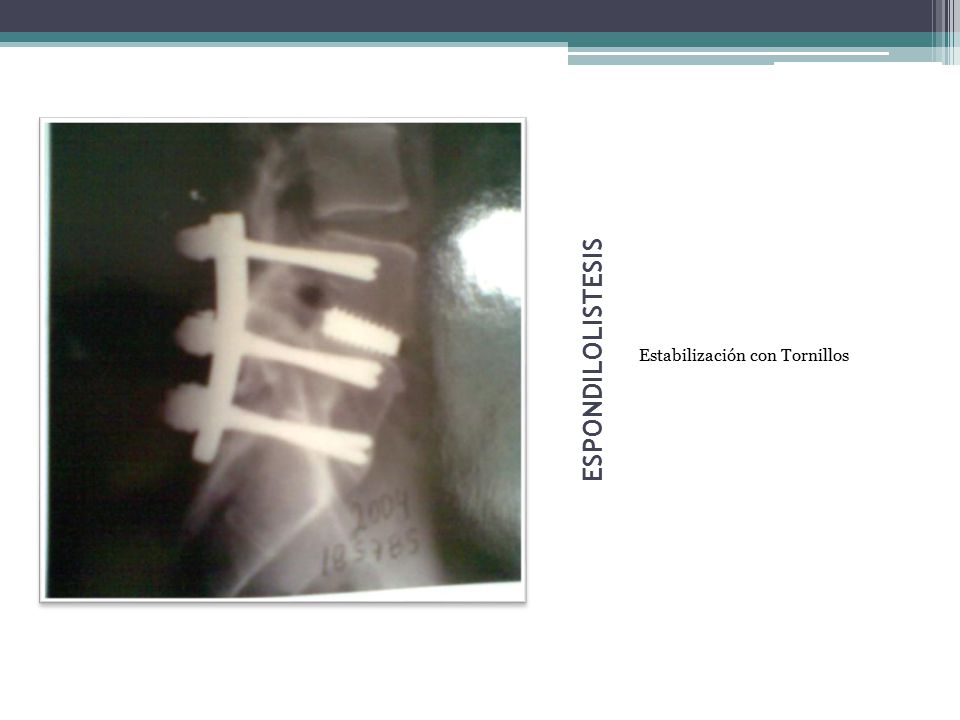 ESPONDILOLISTESIS Estabilización con Tornillos