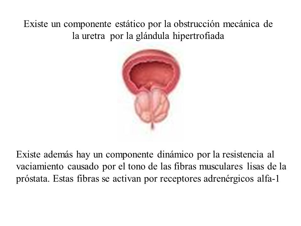 Existe un componente estático por la obstrucción mecánica de la uretra por la glándula hipertrofiada