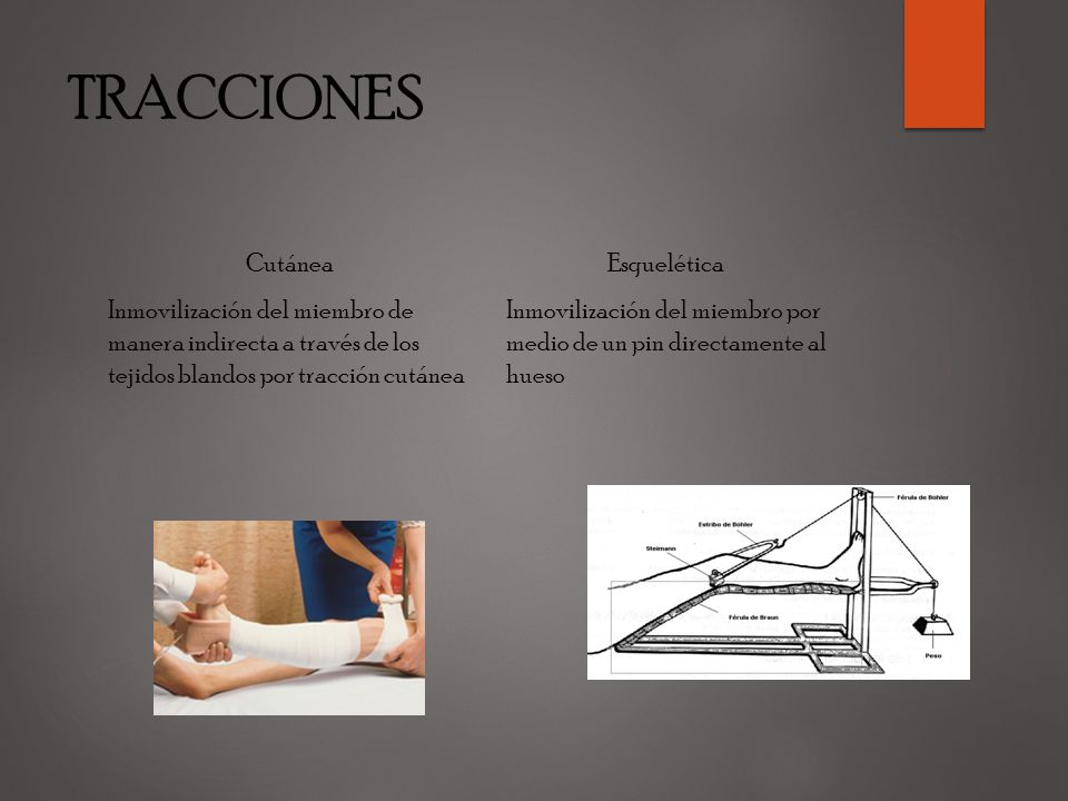 TRACCIONES Cutánea Inmovilización del miembro de manera indirecta a través de los tejidos blandos por tracción cutánea