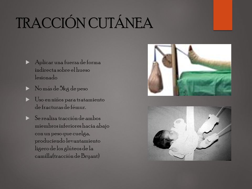 TRACCIÓN CUTÁNEA Aplicar una fuerza de forma indirecta sobre el hueso lesionado. No más de 5kg de peso.