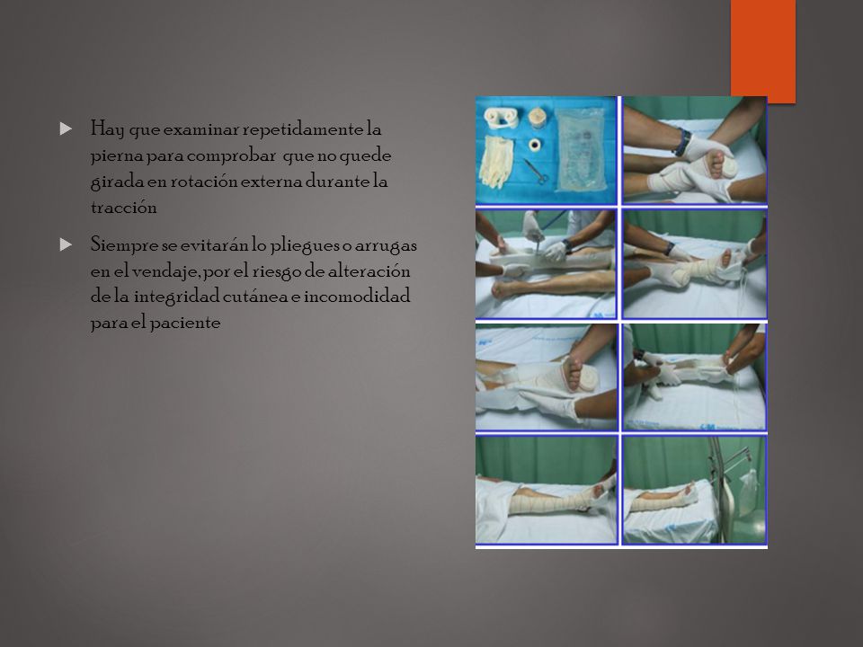 Hay que examinar repetidamente la pierna para comprobar que no quede girada en rotación externa durante la tracción
