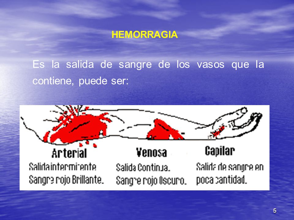 Es la salida de sangre de los vasos que la contiene, puede ser: