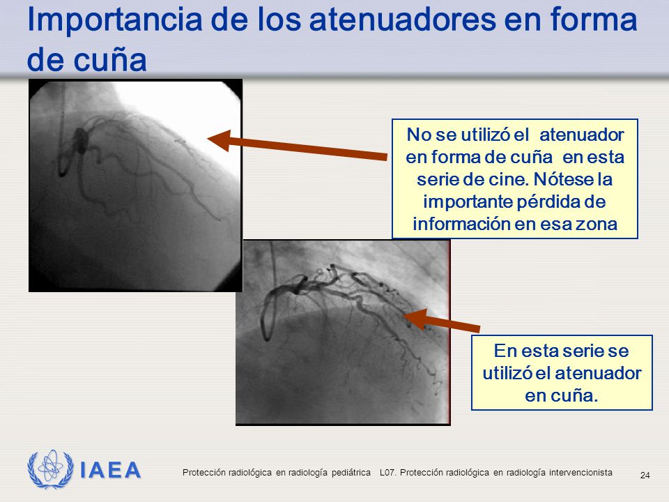 Importancia de los atenuadores en forma de cuña