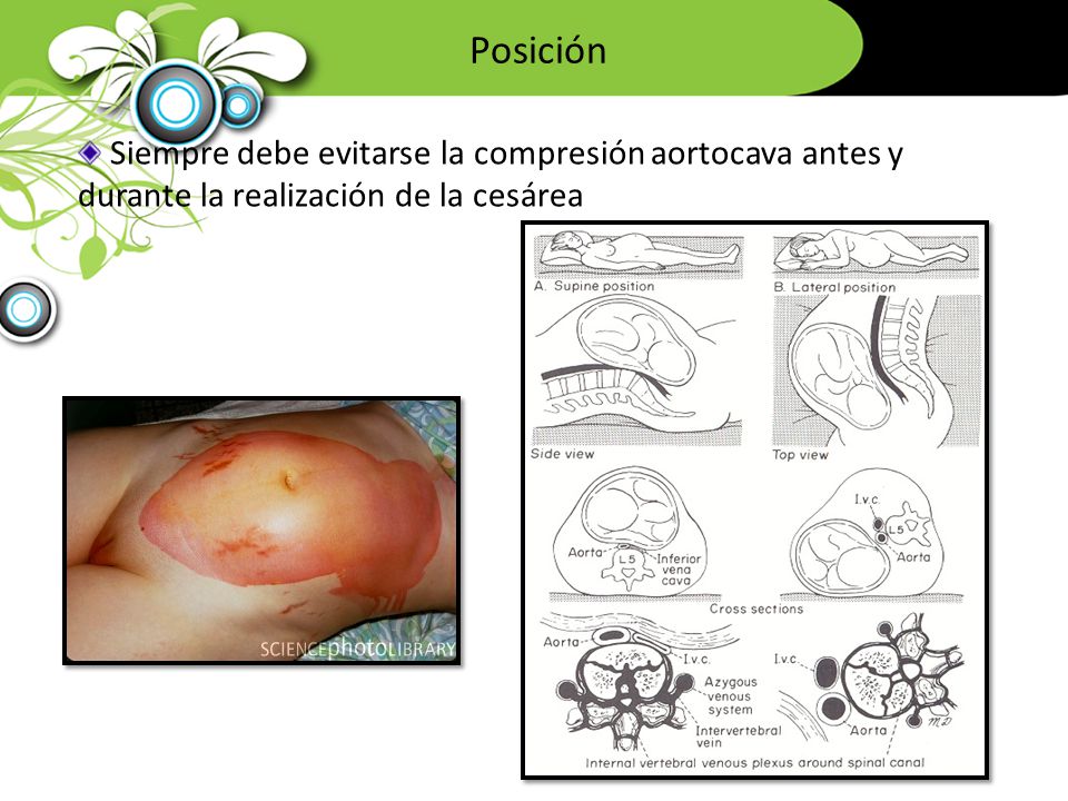 Posición Siempre debe evitarse la compresión aortocava antes y durante la realización de la cesárea.