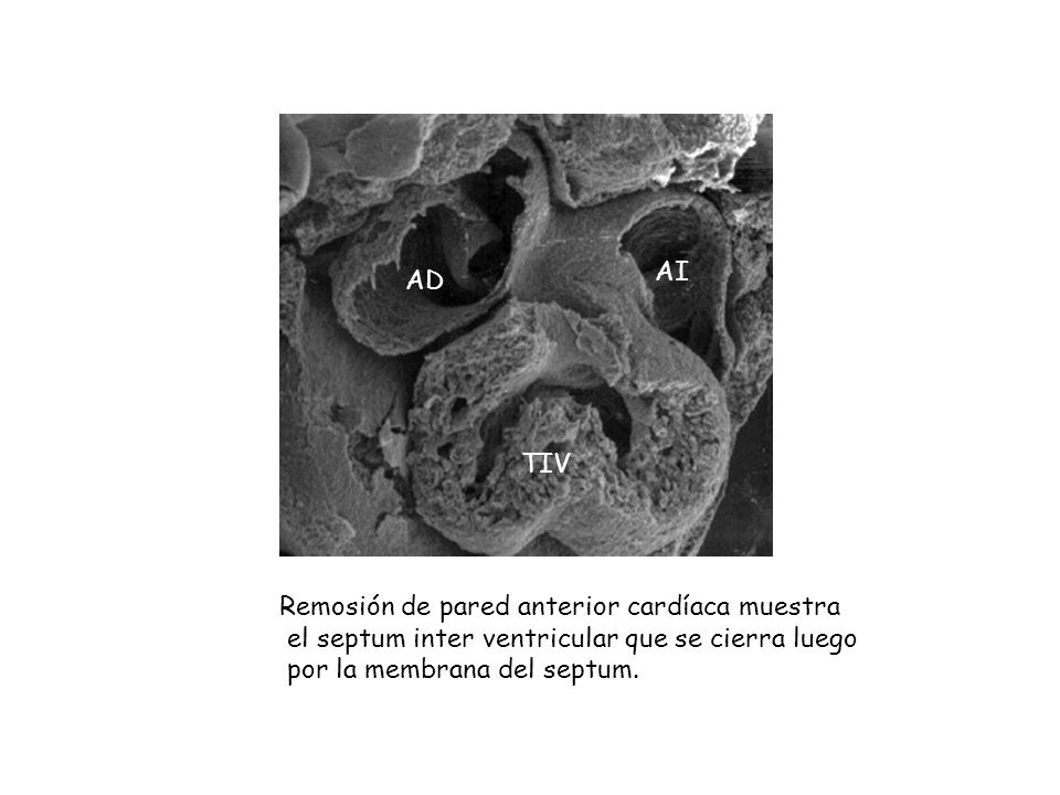 AI AD. TIV. Remosión de pared anterior cardíaca muestra. el septum inter ventricular que se cierra luego.