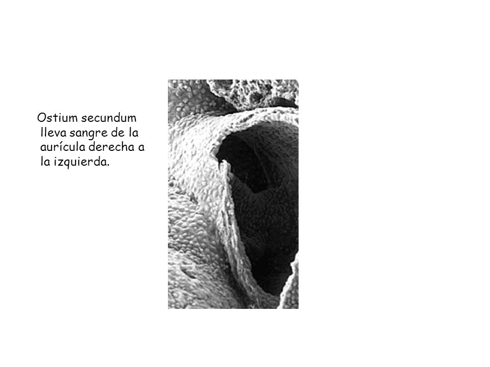 Ostium secundum lleva sangre de la aurícula derecha a la izquierda.