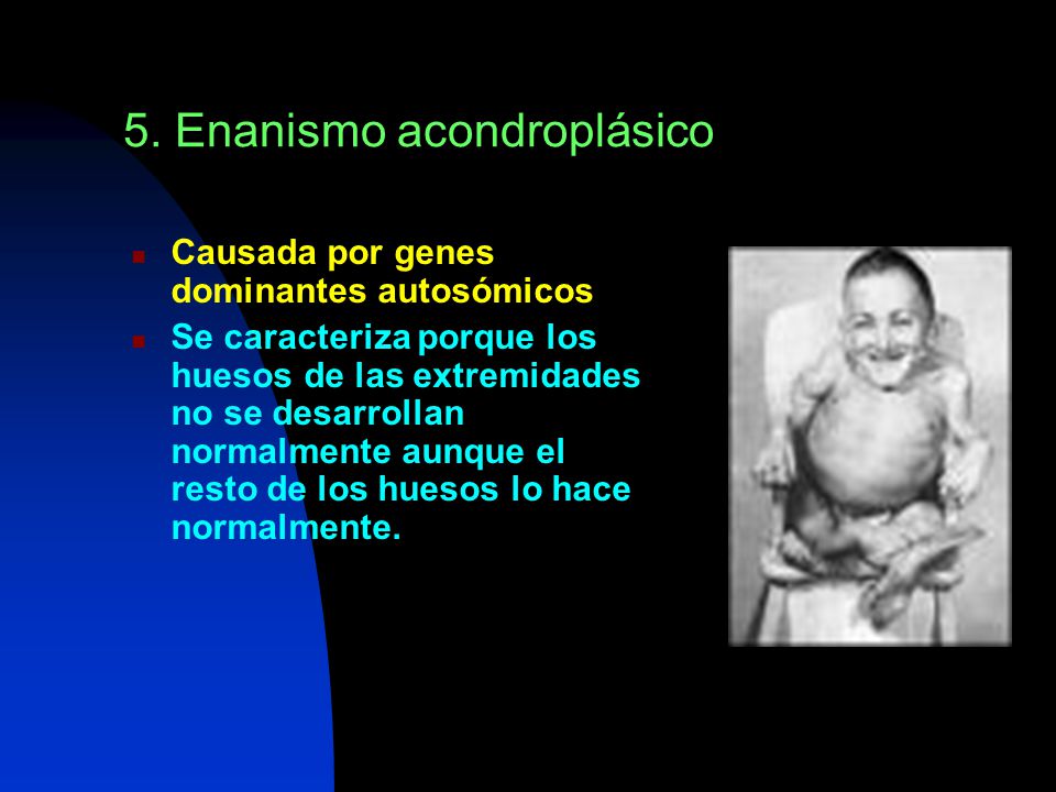 5. Enanismo acondroplásico