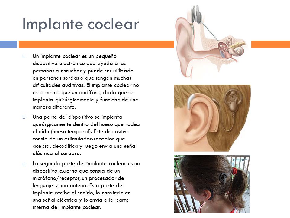 Implante coclear