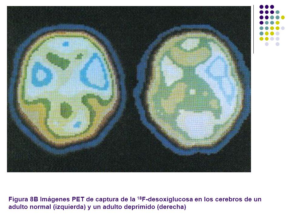 Figura 8B Imágenes PET de captura de la 18F-desoxiglucosa en los cerebros de un adulto normal (izquierda) y un adulto deprimido (derecha)