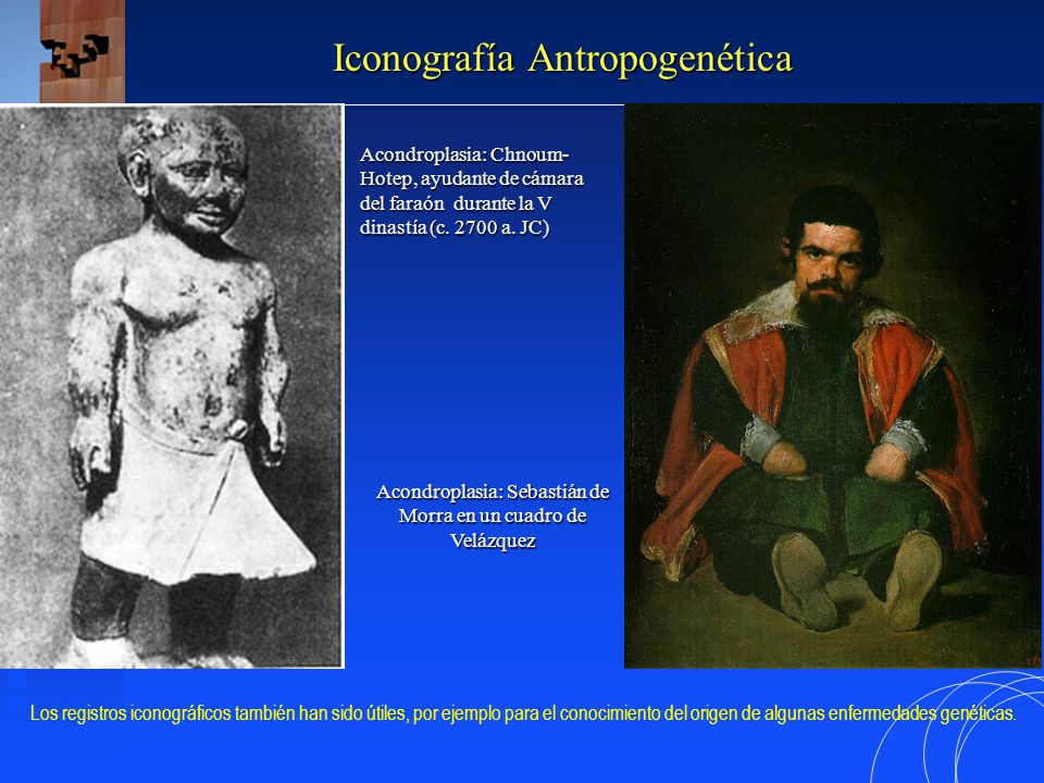 Acondroplasia: Sebastián de Morra en un cuadro de Velázquez